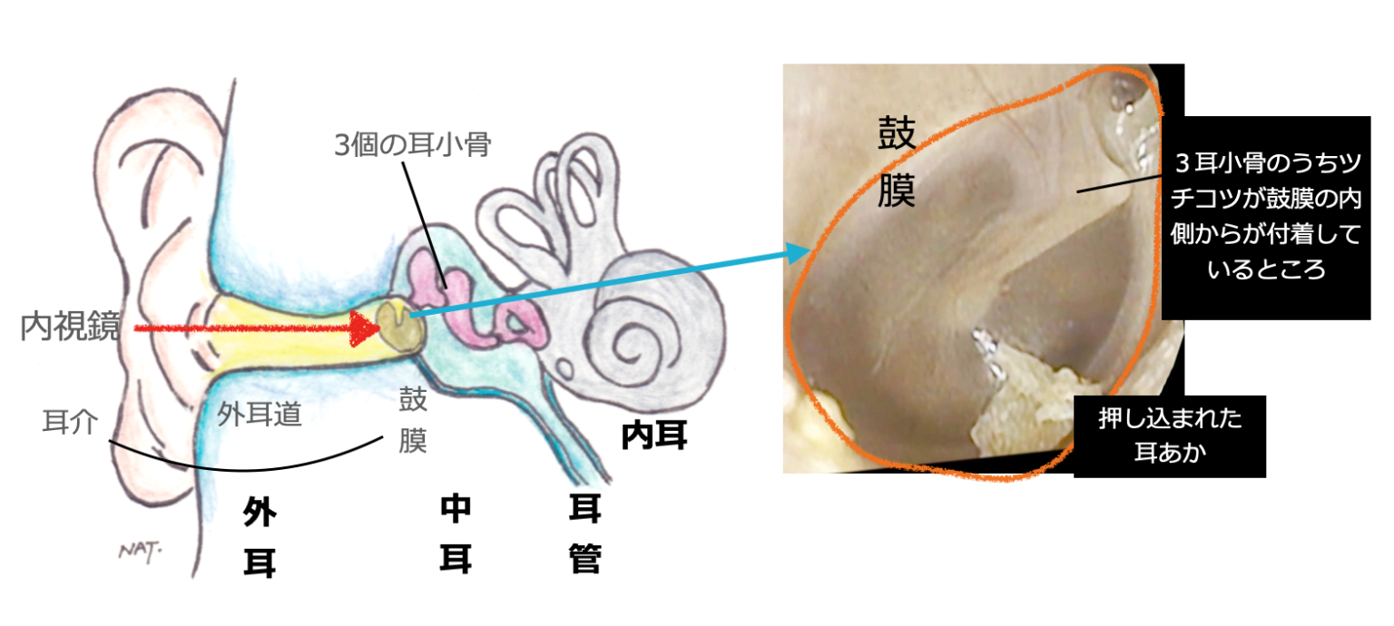 耳の探検 – 白い鳥医院 ブログ